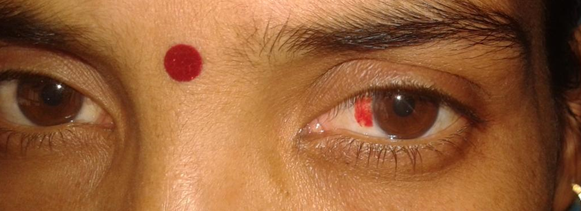 Pterygium Excision CAG