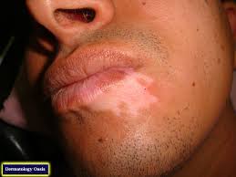 Focal Vitiligo